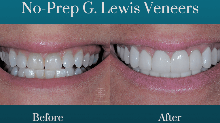 No-Prep G. Lewis Veneers